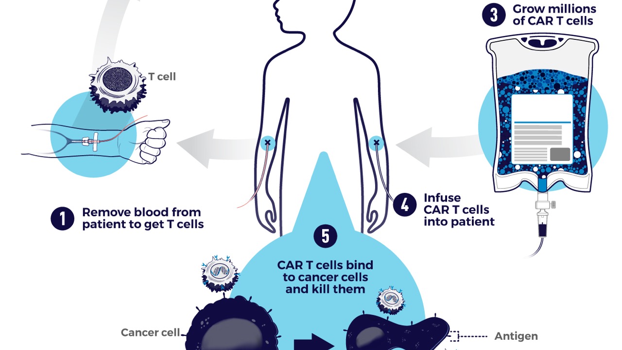 Immune System Reprogramming: Successes and Limitations of CAR-T Cell Therapy